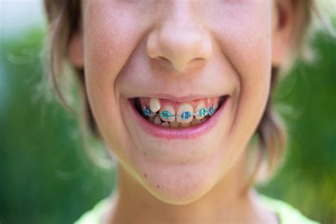 colores de brackets metalicos|color de brackets para hombres.